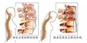 未分化脊柱關(guān)節(jié)炎注意事項(xiàng),單發(fā)性關(guān)節(jié)炎注意事項(xiàng),創(chuàng)傷性關(guān)節(jié)炎的注意事項(xiàng)