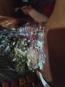 蛇盤瘡飲食需要注意什么,蛇盤瘡注意飲食禁忌,蛇盤瘡患者飲食禁忌