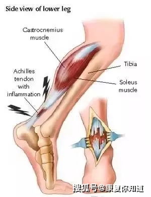 跟腱,斷裂,注意事項,手術(shù)