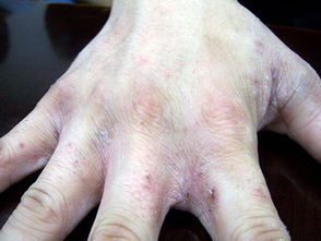 疥瘡的治療及注意事項(xiàng),得了疥瘡的注意事項(xiàng),疥瘡用藥的注意事項(xiàng)