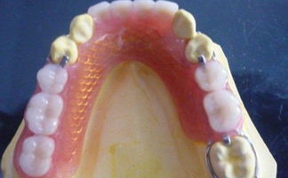 鑲牙注意事項(xiàng)與禁忌癥,老年人鑲牙注意事項(xiàng),鑲牙后注意事項(xiàng)