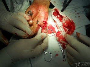 攣縮,瘢痕,注意事項(xiàng)