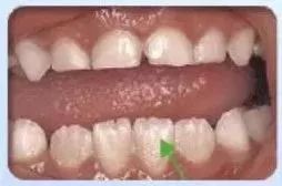 撥下門牙的注意事項,種植門牙注意事項,補完門牙注意事項