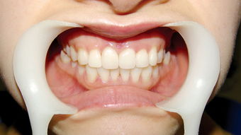 門牙,注意事項(xiàng)