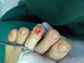 甲下骨疣是的注意事項(xiàng)