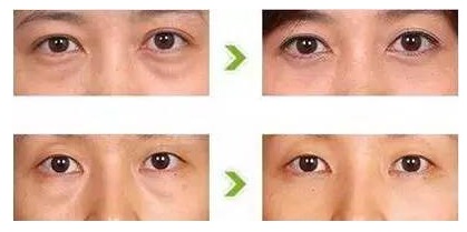 眼袋,注意事項(xiàng),在家