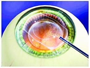 做完晶體植入注意事項,晶體植入手術注意事項,icl晶體植入術注意事項