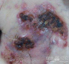 乳腺癌,二期,手術后,注意事項