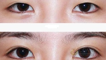 雙眼皮,注意事項