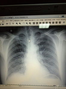 栓塞,腦血管,注意事項