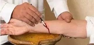 刺血療法禁忌癥與注意事項(xiàng)