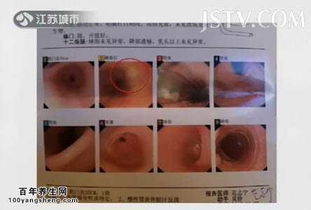 都有,胃鏡,注意事項