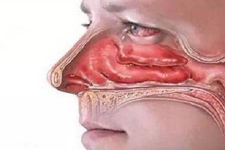 鼻腔血管瘤注意事項張曉輝約