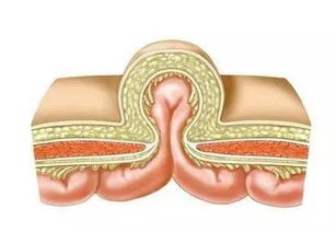 小孩開疝氣手術后注意事項