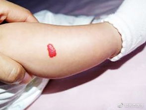 海綿狀血管瘤注意事項