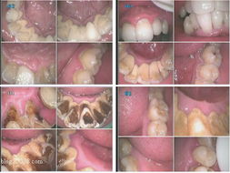 口腔放射注意事項(xiàng)