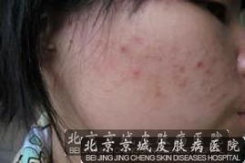 痤瘡,注意事項(xiàng),皮膚