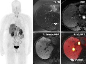 做完petct之后注意事項(xiàng),做完petct注意事項(xiàng),做petct注意事項(xiàng)