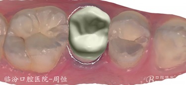 注意事項,戴完嵌體后