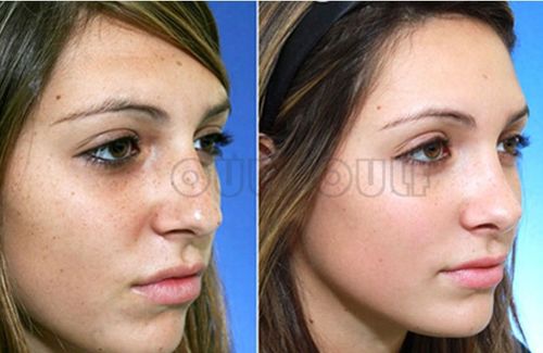 冰點波拉皮注意事項