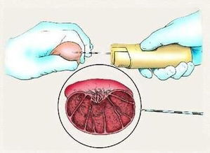 睪丸穿刺活檢注意事項(xiàng)