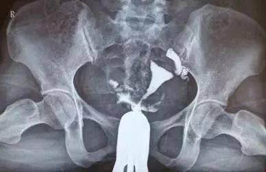 輸暖管造影后注意事項(xiàng)