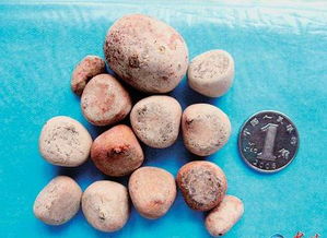 尿結(jié)石碎石后注意事項(xiàng),尿結(jié)石激光碎石后注意事項(xiàng),尿結(jié)石體外碎石后注意事項(xiàng)