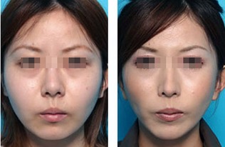 打溶脂針瘦臉注意事項