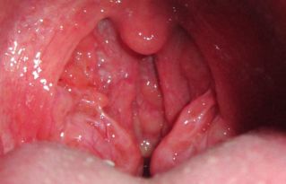 喉嚨長息肉手術(shù)后注意事項,喉嚨息肉飲食注意事項,喉嚨長息肉做完手術(shù)注意事項