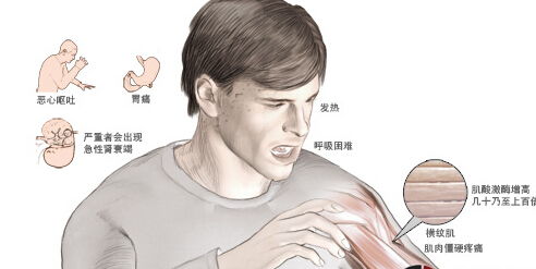 橫紋肌溶解癥治好后就注意事項(xiàng)