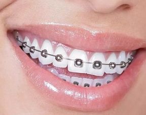 注意事項(xiàng),牙套