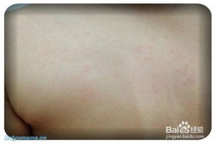 疹子,出了,要注意,事項