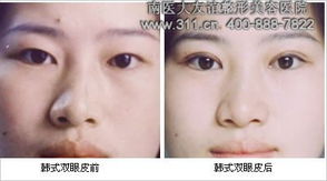 韓式微創(chuàng)雙眼皮術(shù)后注意事項,韓式雙眼皮術(shù)后注意事項有哪些,雙眼皮術(shù)后注意事項及護理