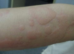 急性蕁麻疹注意事項(xiàng),蕁麻疹疫苗接種注意事項(xiàng),兒童尋麻疹注意事項(xiàng)