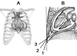 心包,穿刺,注意事項(xiàng)