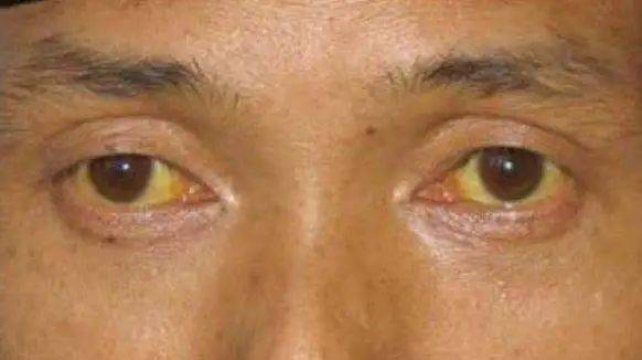 肝豆要注意事項