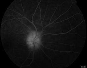 視神經(jīng)乳頭炎的癥狀,視神經(jīng)乳頭炎的原因,急性視神經(jīng)乳頭炎