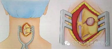 駝背手術(shù)需要注意事項(xiàng)