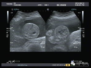 超聲檢查的注意事項(xiàng),婦科超聲檢查注意事項(xiàng),食道超聲檢查注意事項(xiàng)