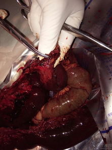 腦血管栓塞術(shù)后注意事項,腦血管介入栓塞術(shù),腦血管動脈瘤栓塞術(shù)