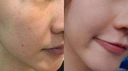 激光做刺后注意事項