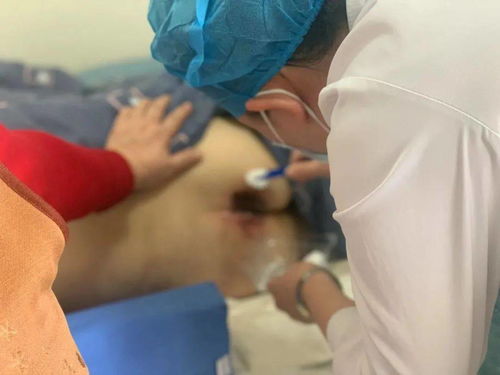 留直導(dǎo)尿注意事項(xiàng)