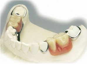 鑲牙咬牙印的注意事項