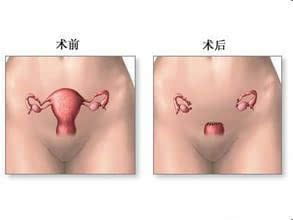 子宮次全切除術(shù)后注意事項