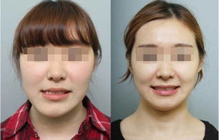 面部不對稱整形注意事項