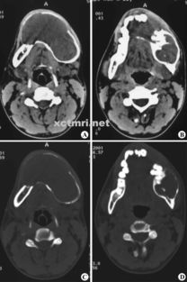 造釉細胞瘤術(shù)后注意事項,脛骨造釉細胞瘤臨床表現(xiàn),脛骨造釉細胞瘤存活率