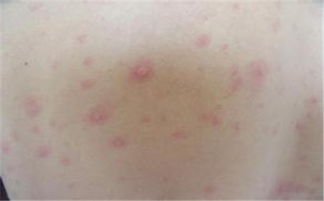 梅毒患者注意事項(xiàng)飲食