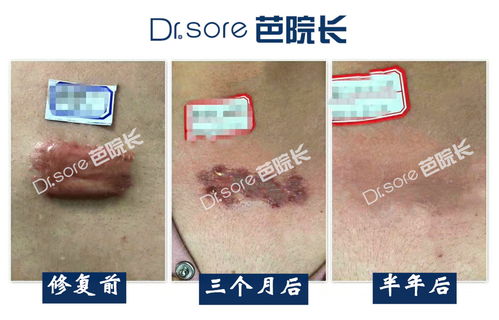 疤痕切除術(shù)后注意事項