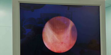 精囊鏡微創(chuàng)手術(shù)后注意事項(xiàng)