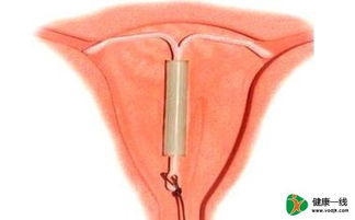 取節(jié)育環(huán)前的注意事項